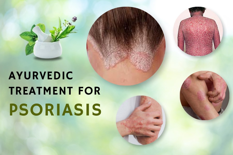 Ayurvedic Treatment For Psoriasis